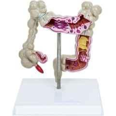 Artsy PVC Large Intestine Pathology Model with Stand & Keycard, OE-U4AS-I25Y